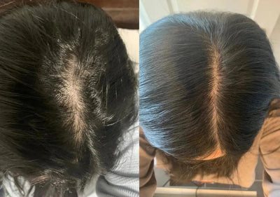 Scalp Reviver PRO - Hair Growth Stimulation Device