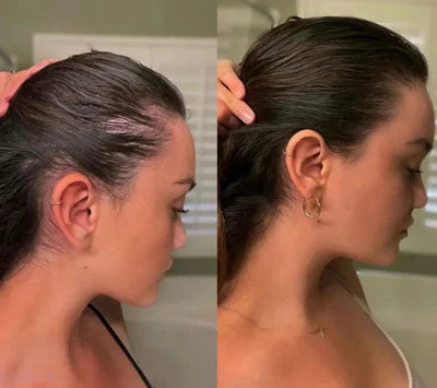 Scalp Reviver PRO - Hair Growth Stimulation Device