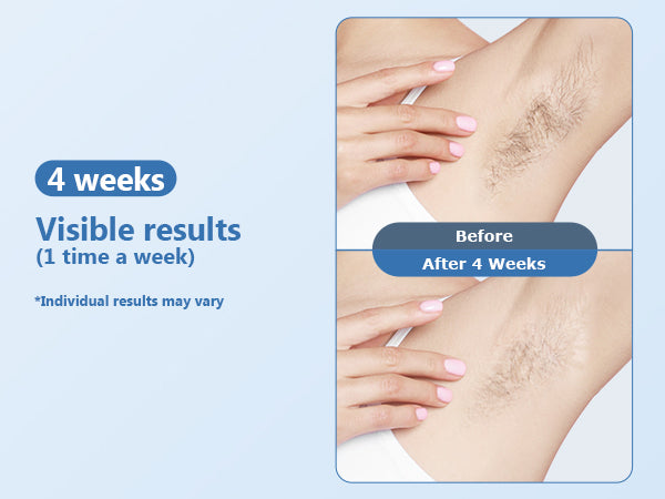 IPL Laser Hair Removal 3-in-1 - Home Device Cooling