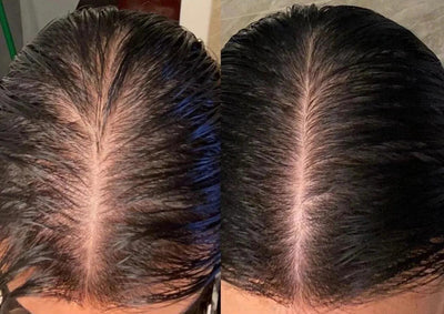 Scalp Reviver PRO - Hair Growth Stimulation Device