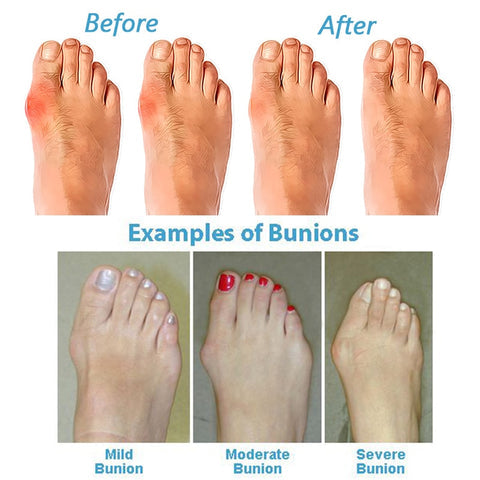 Comfy Orthopedic Platform Sandals for Women