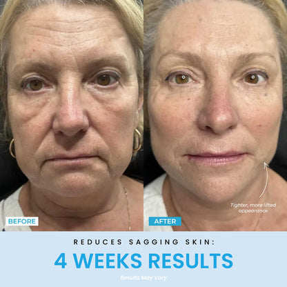 LED Neck Firming Device Anti-aging &amp; Wrinkle Reduction