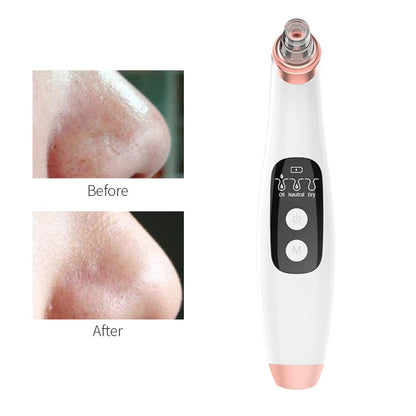 Advanced Pore Vacuum &amp; Blackhead Extractor 2025