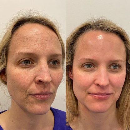 Pore Vacuum Pro